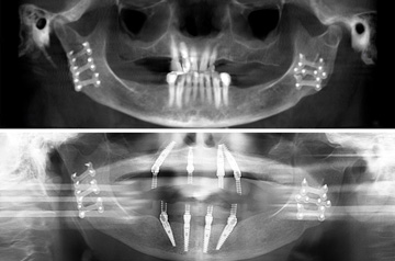 Immediate Implants and Teeth CT Scan View "Before" and "After"