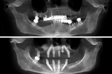 Immediate Implants and Teeth CT Scan View "Before" and "After"
