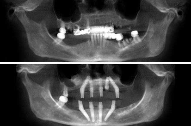 Immediate Implants and Teeth CT Scan View "Before" and "After"