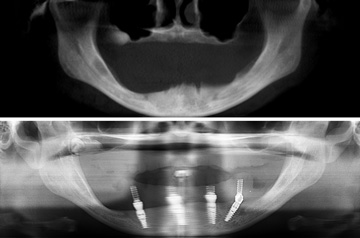 Immediate Implants and Teeth CT-Scan View "Before" and "After"