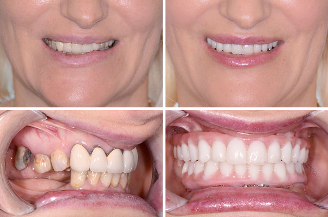Bite Before and After Immediate Implants and Teeth Surgery