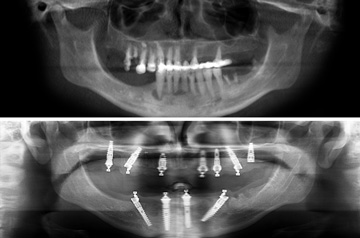 Immediate Implants and Teeth CT Scan View "Before" and "After"