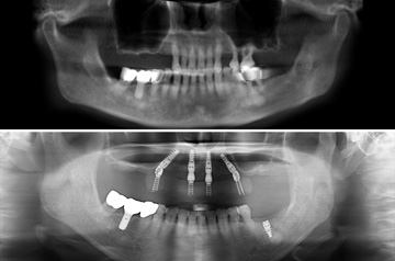 Bite Before and After Immediate Implants on Upper Jaw and Teeth Surgery