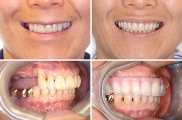 Immediate Implants and Teeth on Upper Jaw Cone Beam CT Scan View "Before" and "After"