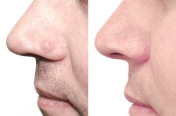 Scarless Mole Removal from Nose Before and After three-quaters view
