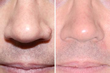 Scarless Mole Removal from Nose Before and After front view