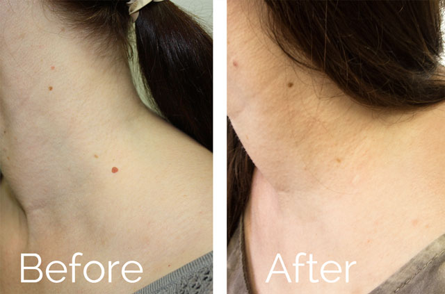 Neck mole scarless removal before and after picture