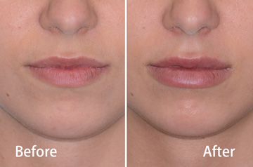 Juvederm&reg; lips frontal view before and after fillers