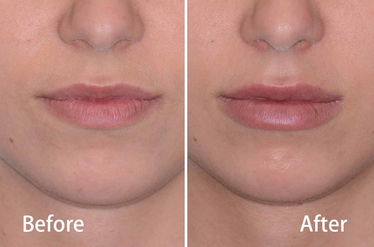 Juvederm® Lips Fillers Facial Cosmetic Surgery Dr Antipov