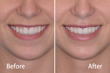Juvederm&reg; lips frontal view before and after fillers with a smile