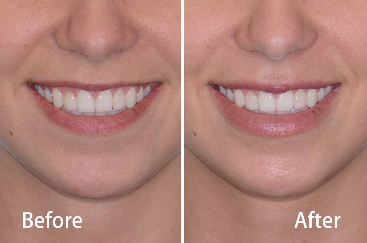 Juvederm® Lips Fillers Facial Cosmetic Surgery Dr. Antipov