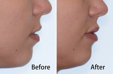 Juvederm&reg; lips profile view before and after fillers with released lips