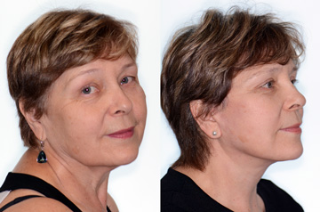 Face lifting surgery results: Before and After, three quaters view