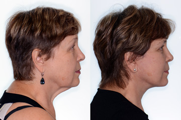 Face lifting surgery results: Before and After, profile view