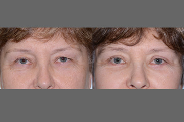Face lifting surgery results: Before and After, close up eyes view