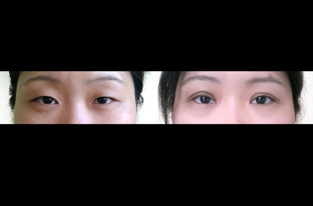 Female patient wanted to correct her asian eyelids