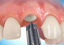 Single dental implant