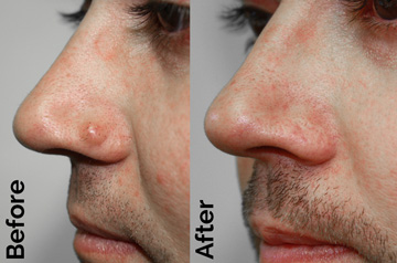 Before and after mole removal