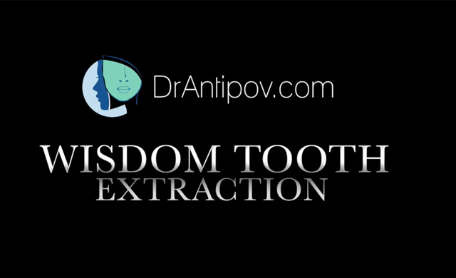 video presentation of the wisdom teeth extraction in the Galleria Oral and Maxillofacial Surgery Center
