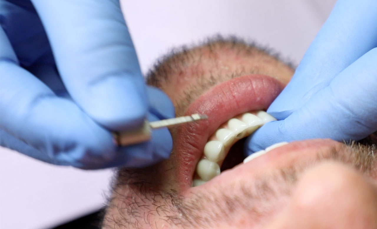 video of live oral surgery