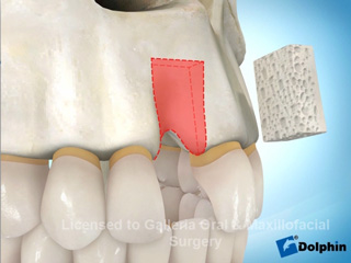 Block Bone Graft for Implant