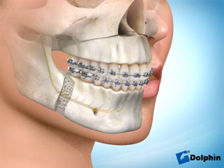 Corrective Jaw Surgery