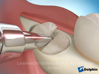 Third Molar Extraction (Partial Boney Impaction)