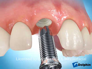 Single Implant with Anterior Socket Grafting