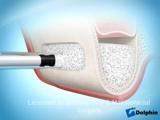 Sinus Lift