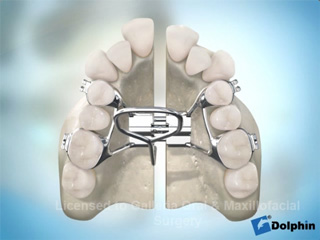 Surgically Assisted Palatal Expansion