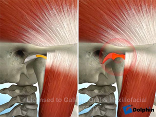 TMJ Anterior Disc Displacement