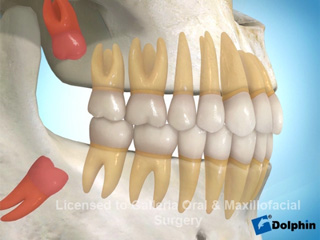 Wisdom Teeth Eruption